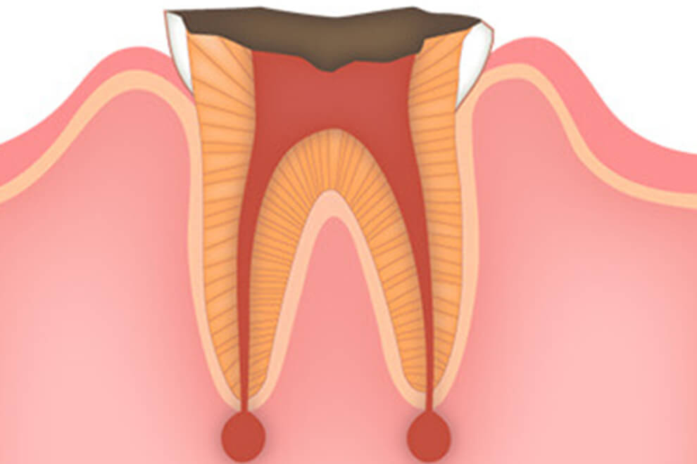 歯内療法が必要な状態とは？